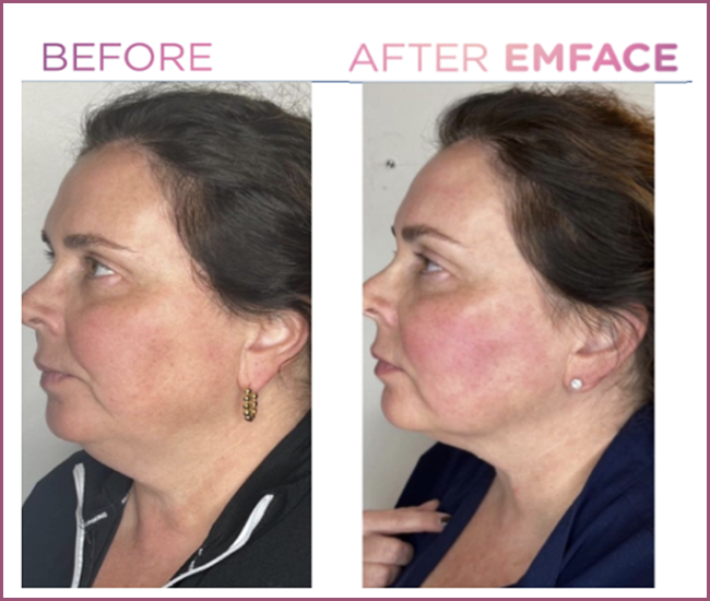 Emface before and after — Chin + Jawline (Submentum)