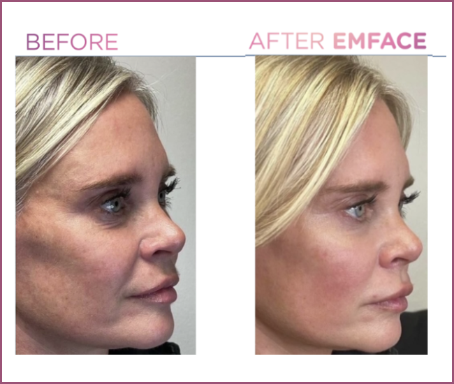 Emface before and after — Full Face