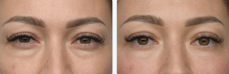 Emface before and after — Eyes