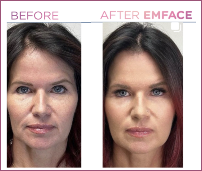 Emface before and after — Full Face