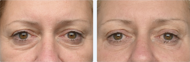 Emface before and after — Eyes